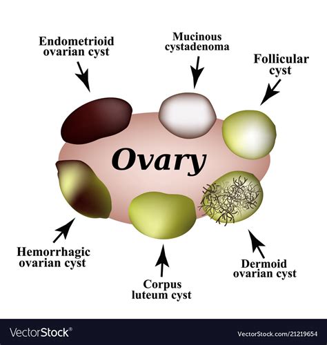ovarian cysts types and names.